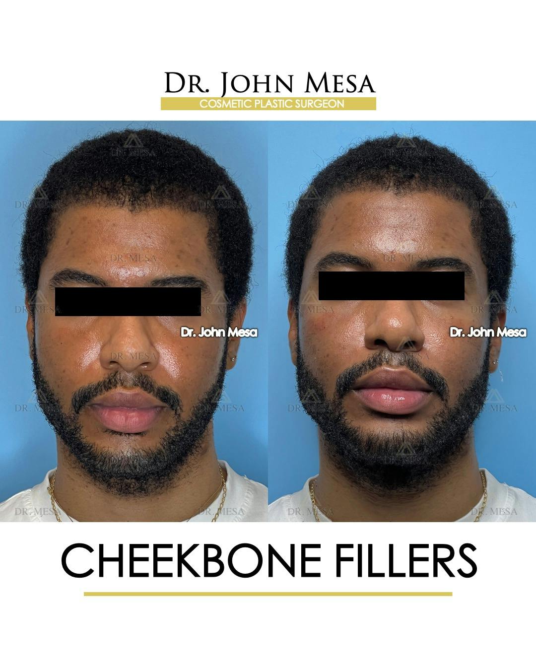 Cheekbone Filler Before & After Gallery - Patient 177279 - Image 1
