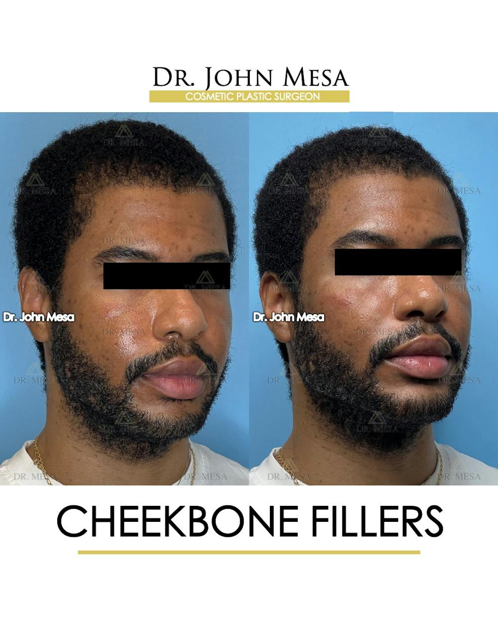 Cheekbone Filler Before & After Gallery - Patient 177279 - Image 2