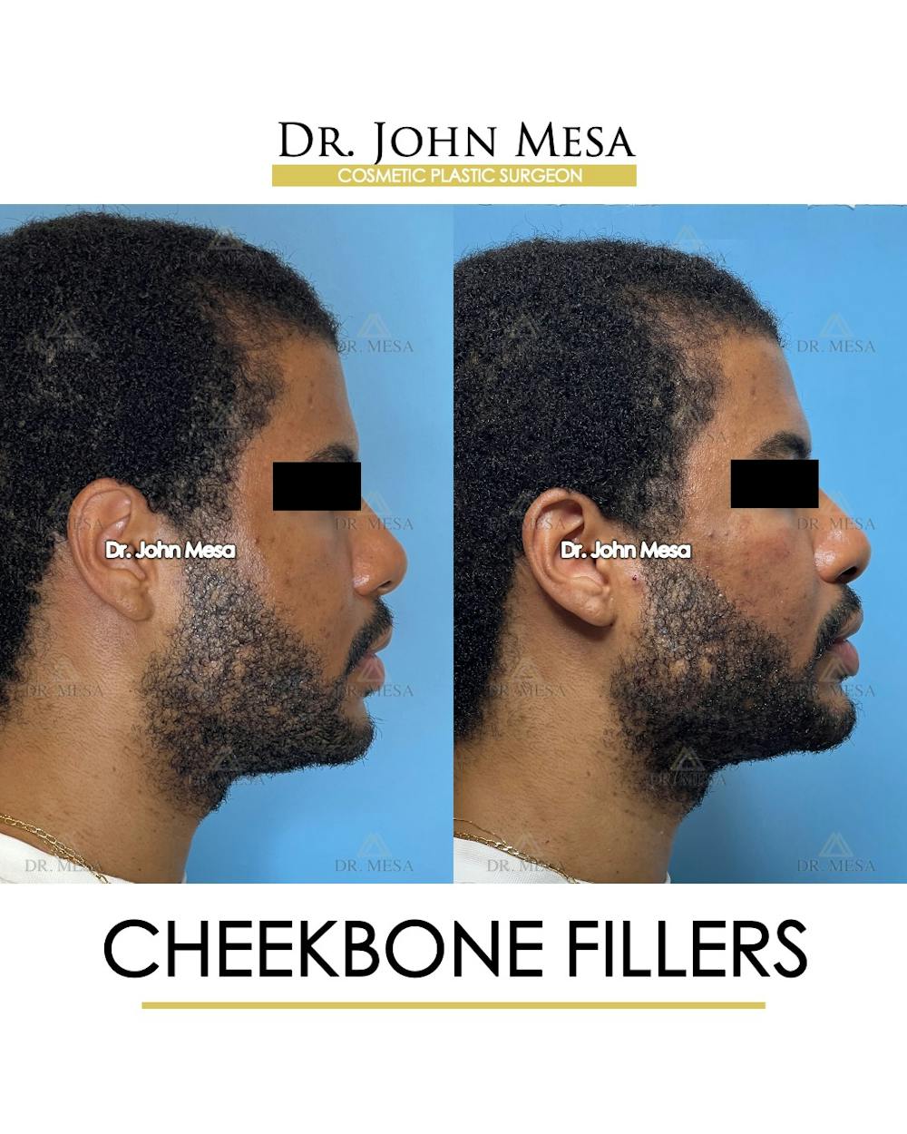 Cheekbone Filler Before & After Gallery - Patient 177279 - Image 3