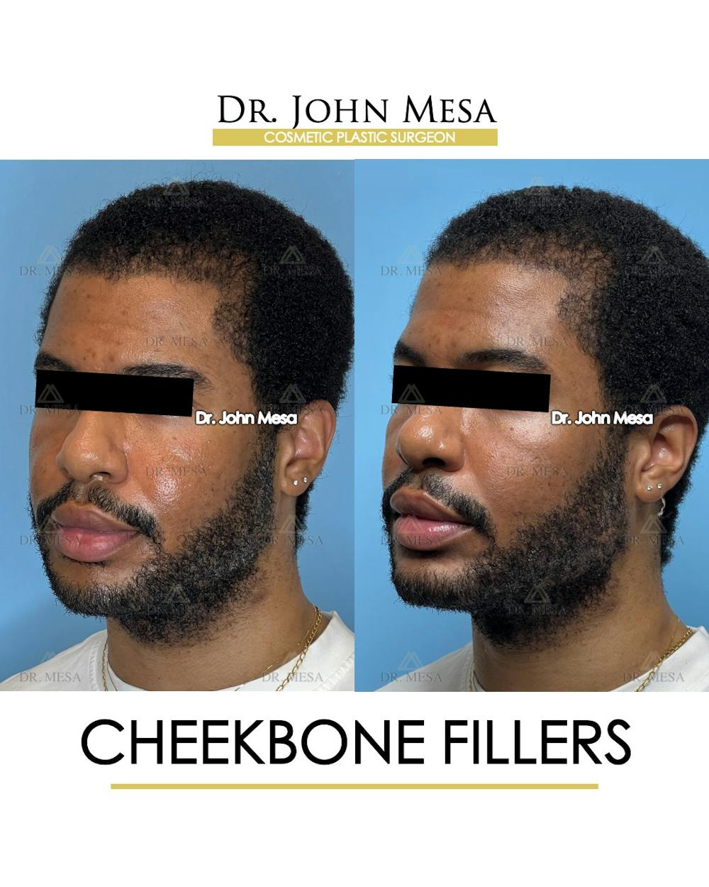 Cheekbone Filler Before & After Gallery - Patient 177279 - Image 4