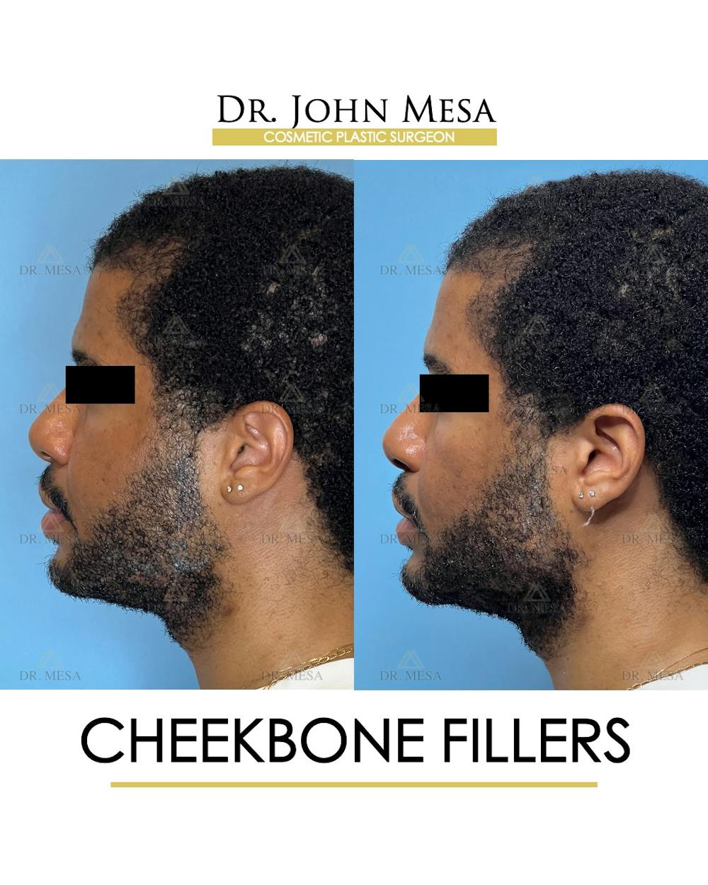 Cheekbone Filler Before & After Gallery - Patient 177279 - Image 5