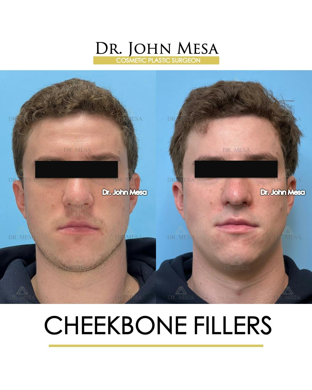 Cheekbone Filler Before & After Gallery - Patient 115678 - Image 1