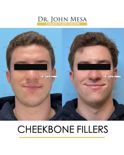 Cheekbone Filler Before & After Gallery - Patient 115678 - Image 2