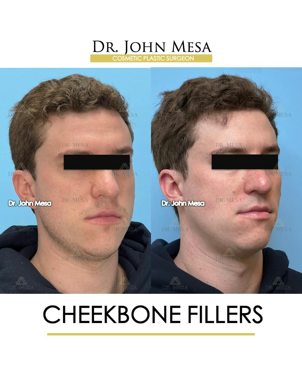 Cheekbone Filler Before & After Gallery - Patient 115678 - Image 3