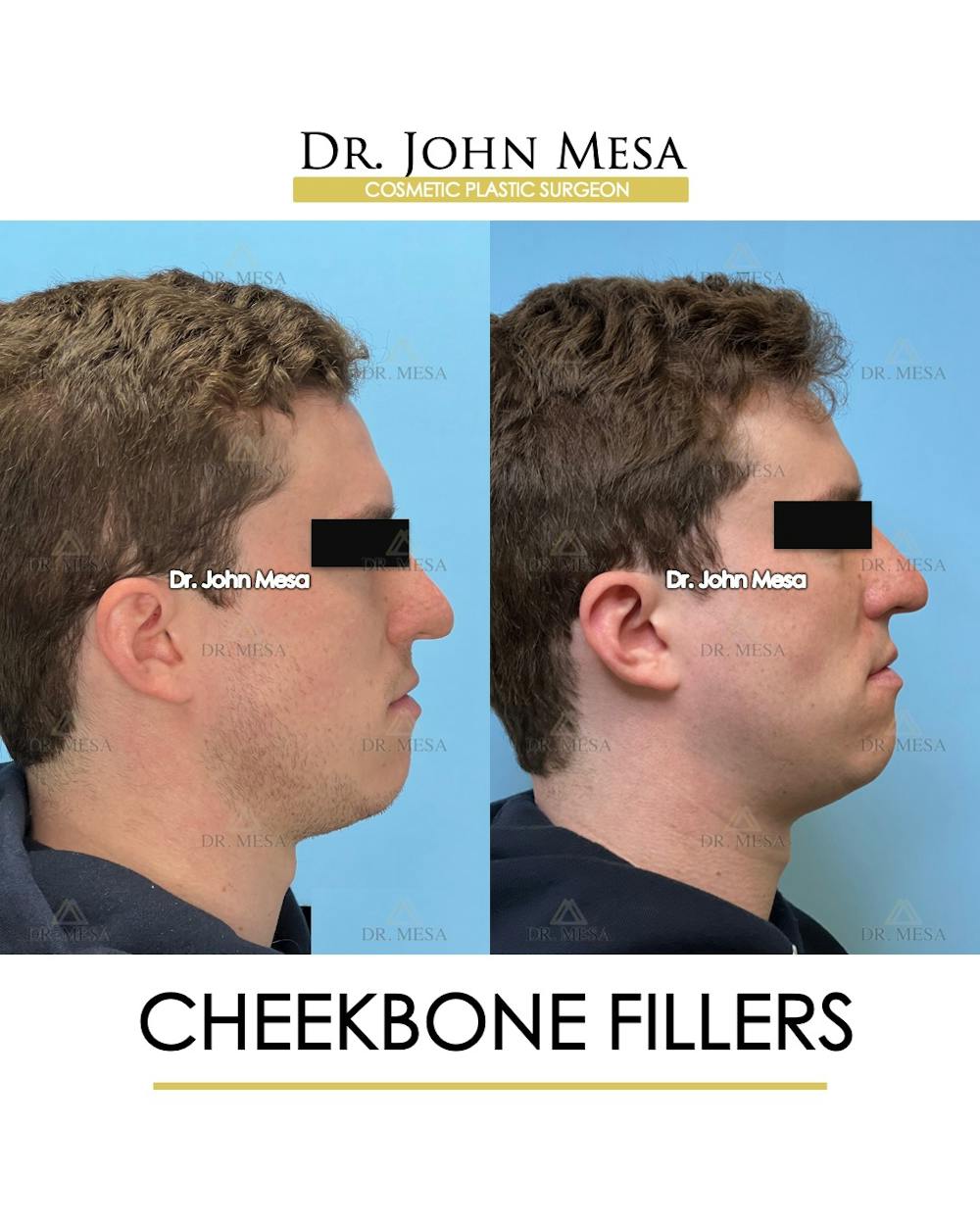 Cheekbone Filler Before & After Gallery - Patient 115678 - Image 4