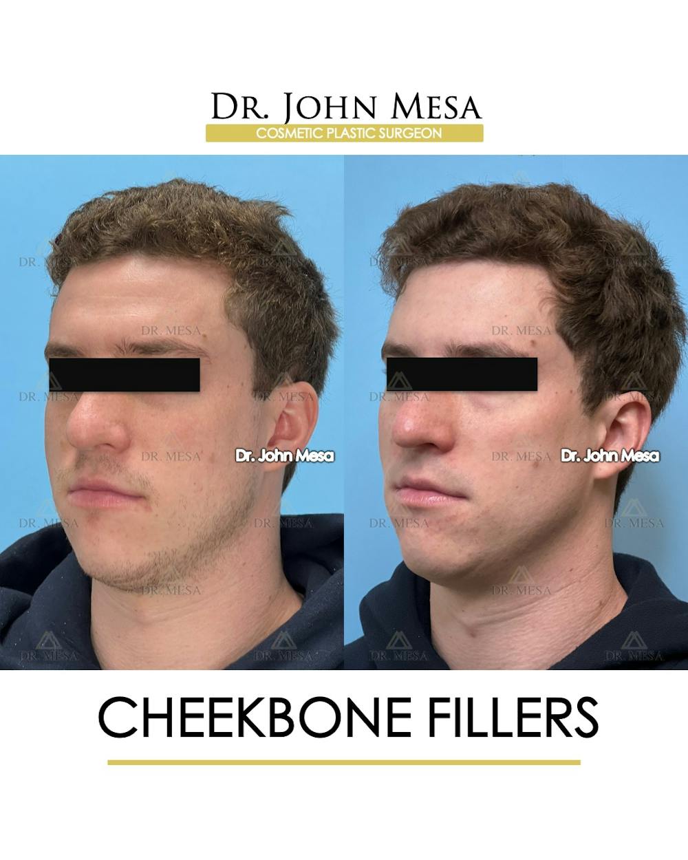 Cheekbone Filler Before & After Gallery - Patient 115678 - Image 5