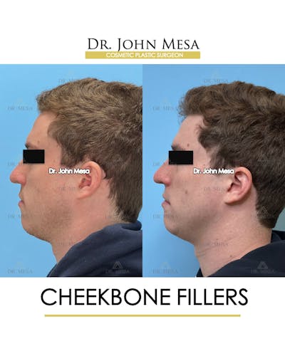 Cheekbone Filler Before & After Gallery - Patient 115678 - Image 6