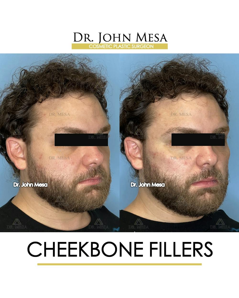 Cheekbone Filler Before & After Gallery - Patient 411968 - Image 2