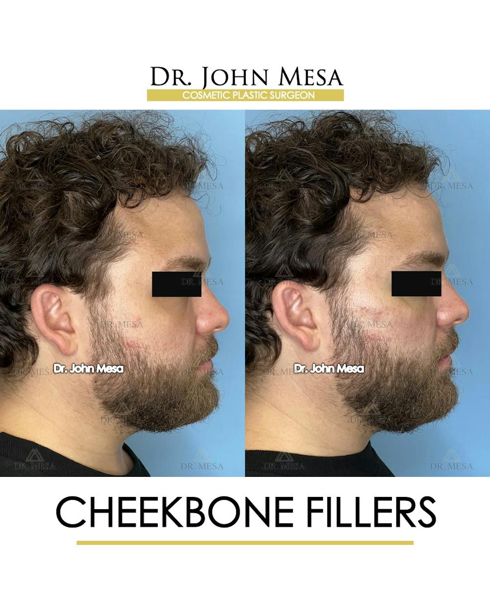 Cheekbone Filler Before & After Gallery - Patient 411968 - Image 3