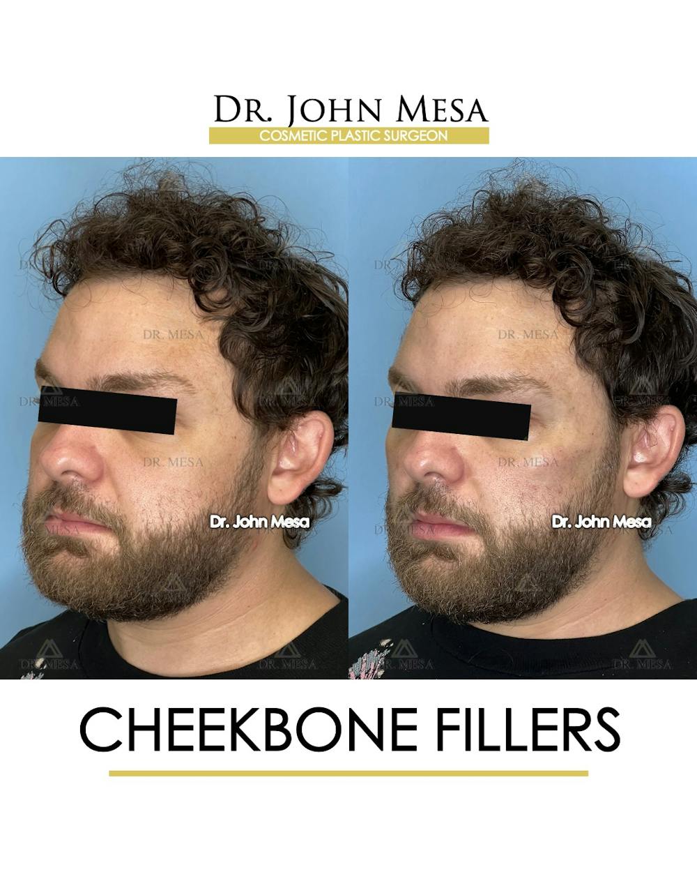 Cheekbone Filler Before & After Gallery - Patient 411968 - Image 4