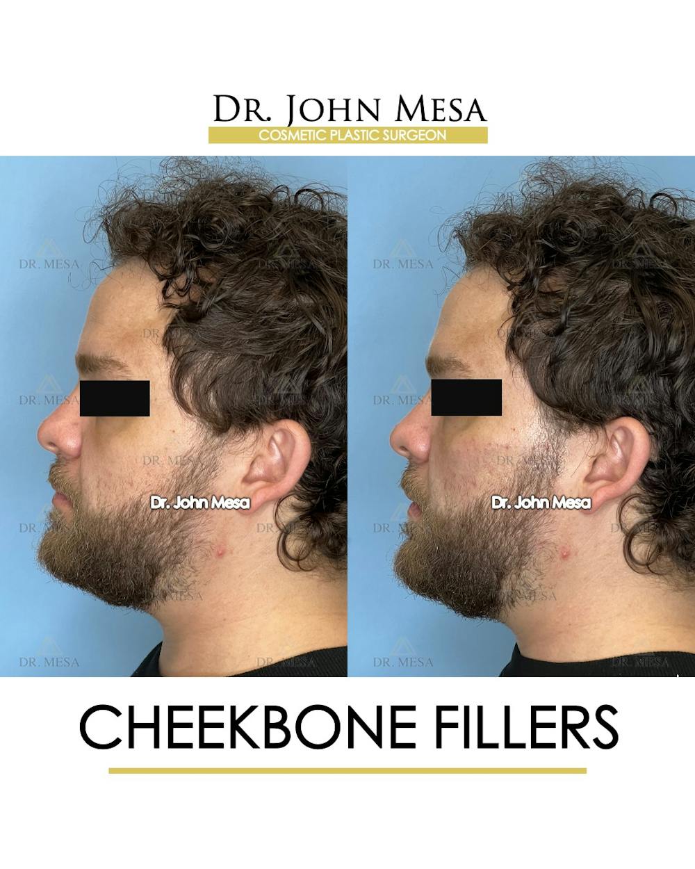 Cheekbone Filler Before & After Gallery - Patient 411968 - Image 5