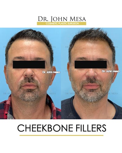 Cheekbone Filler Before & After Gallery - Patient 405782 - Image 1