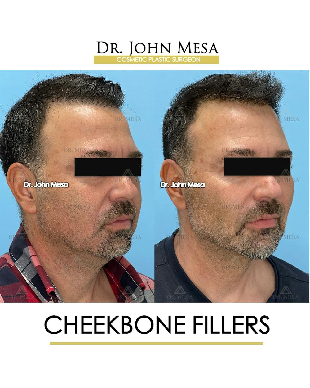 Cheekbone Filler Before & After Gallery - Patient 405782 - Image 2
