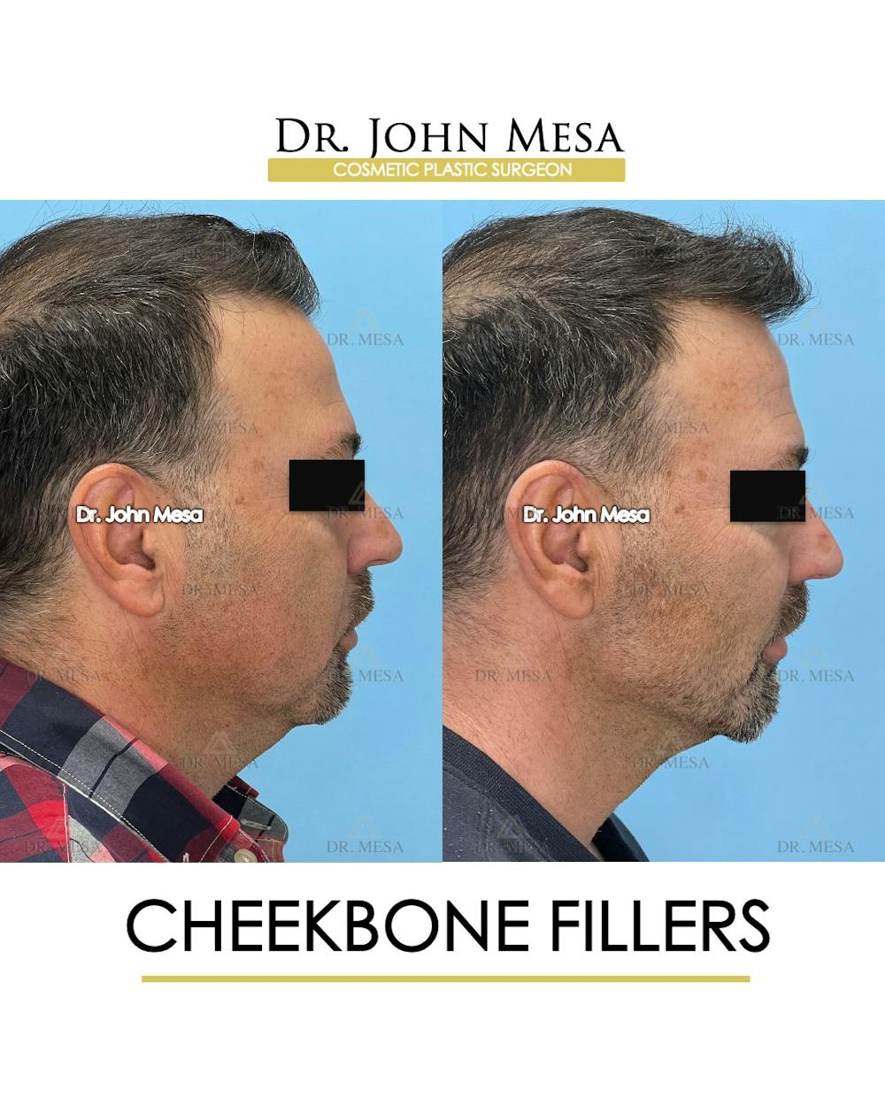 Cheekbone Filler Before & After Gallery - Patient 405782 - Image 3