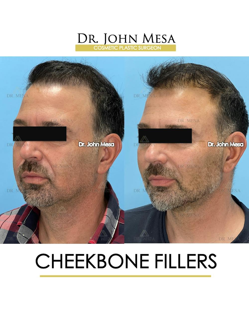 Cheekbone Filler Before & After Gallery - Patient 405782 - Image 4