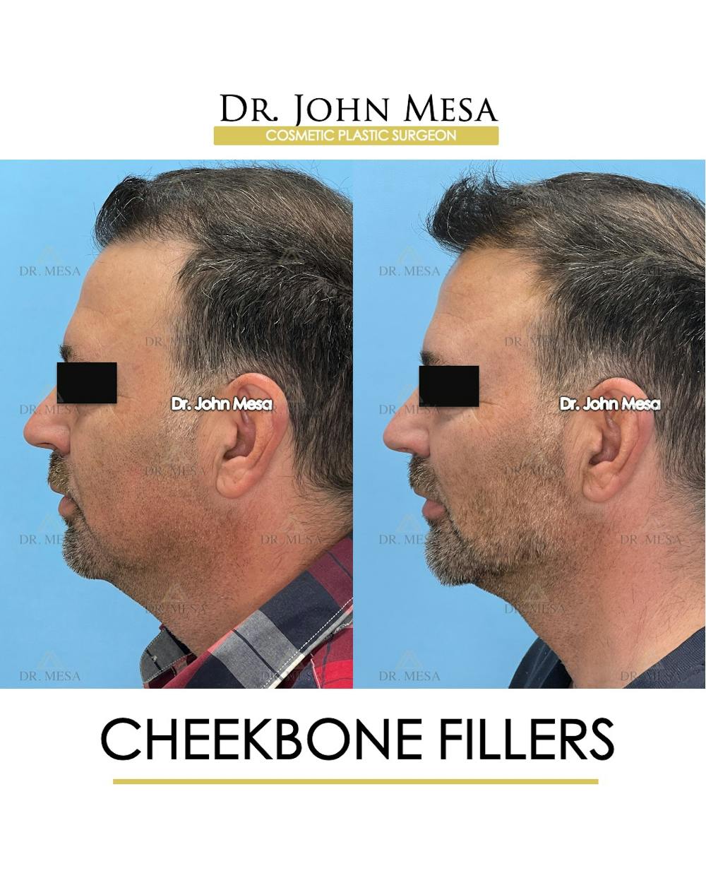 Cheekbone Filler Before & After Gallery - Patient 405782 - Image 5