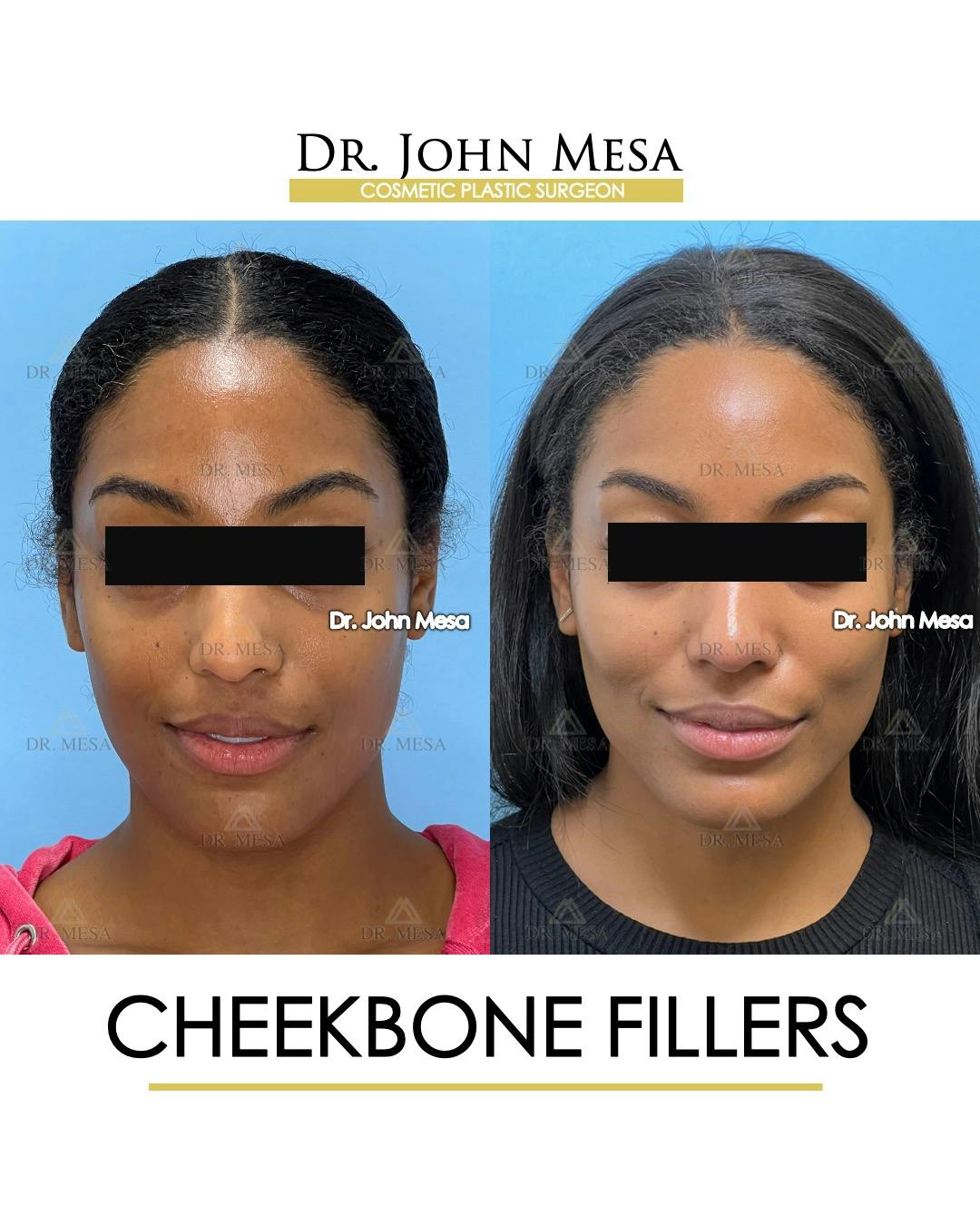 Cheekbone Filler Before & After Gallery - Patient 305868 - Image 1