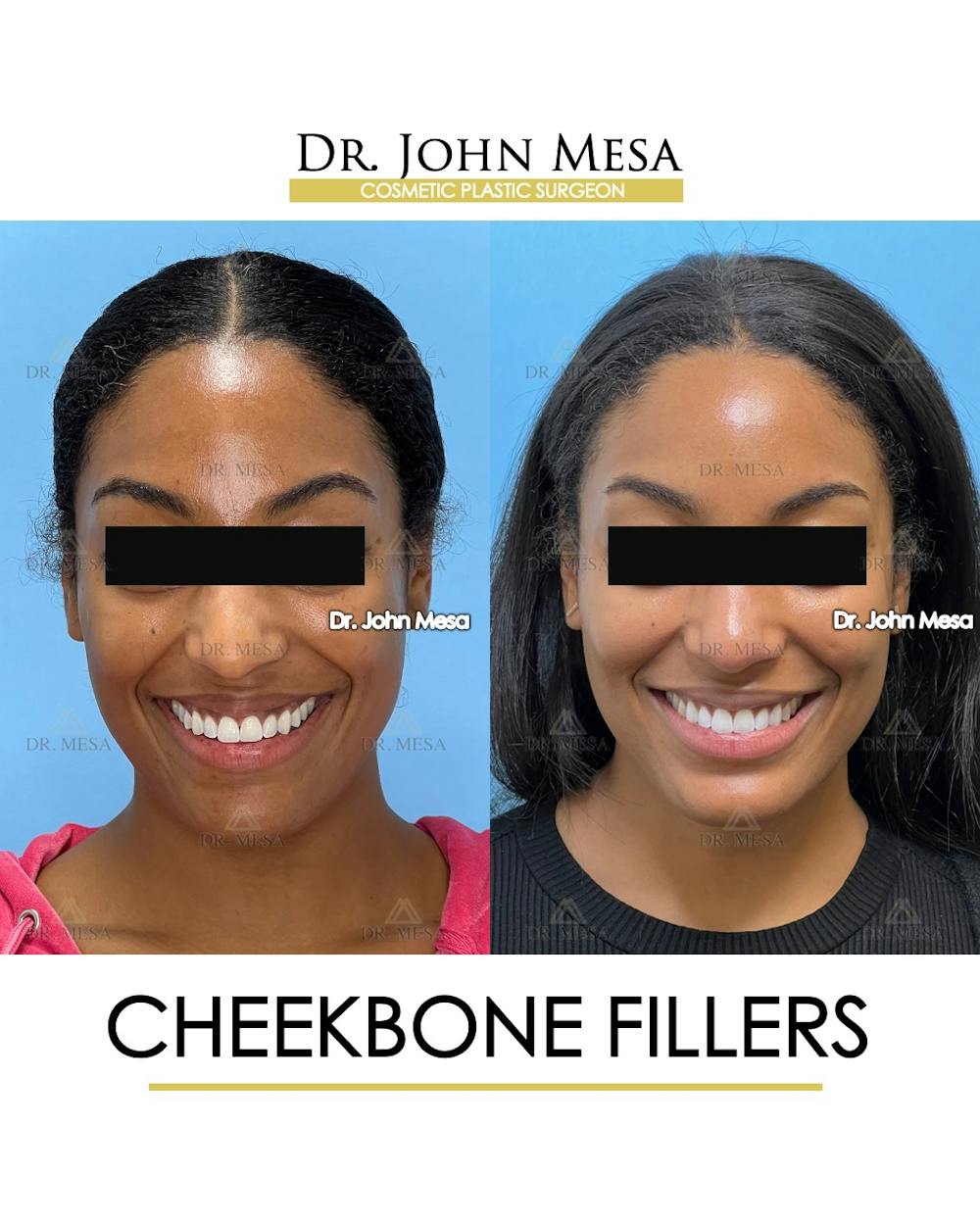 Cheekbone Filler Before & After Gallery - Patient 305868 - Image 2