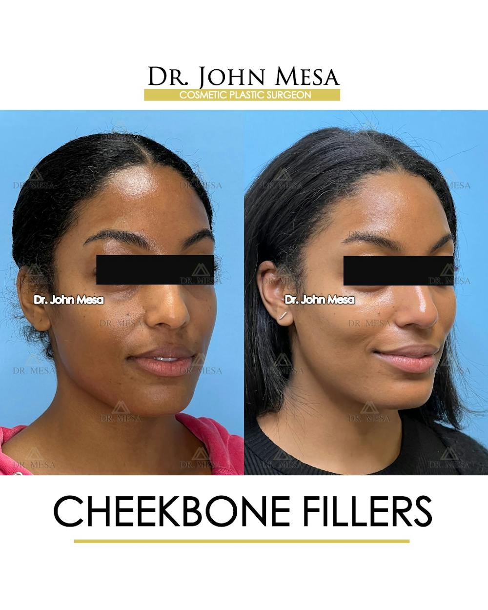 Cheekbone Filler Before & After Gallery - Patient 305868 - Image 3