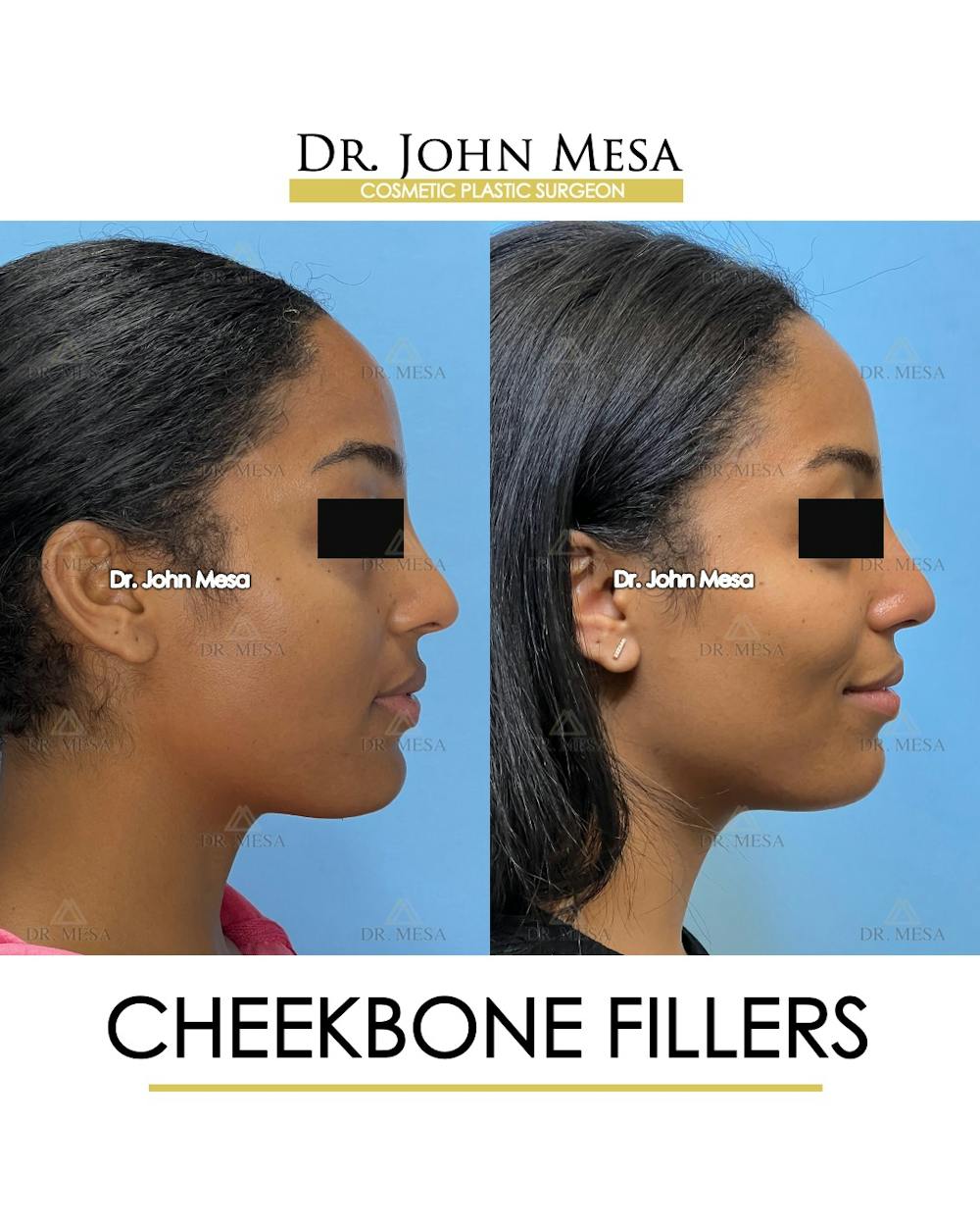 Cheekbone Filler Before & After Gallery - Patient 305868 - Image 4