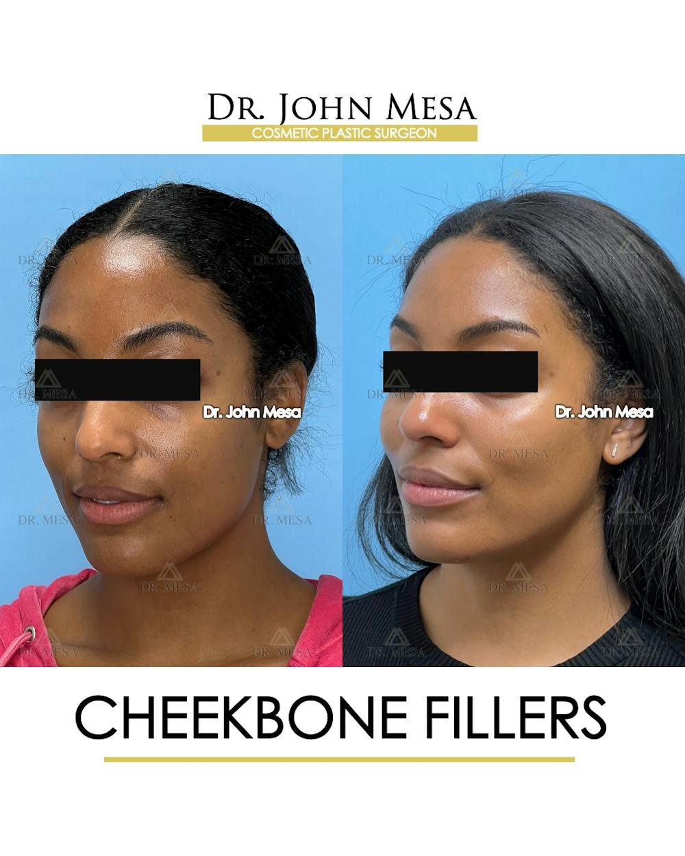 Cheekbone Filler Before & After Gallery - Patient 305868 - Image 5