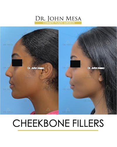 Cheekbone Filler Before & After Gallery - Patient 305868 - Image 6