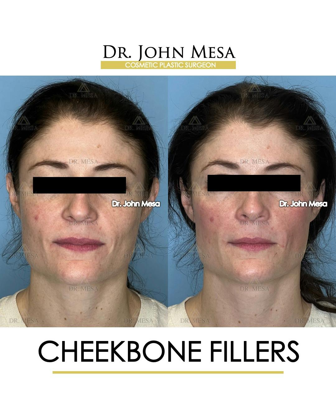 Cheekbone Filler Before & After Gallery - Patient 418893 - Image 1