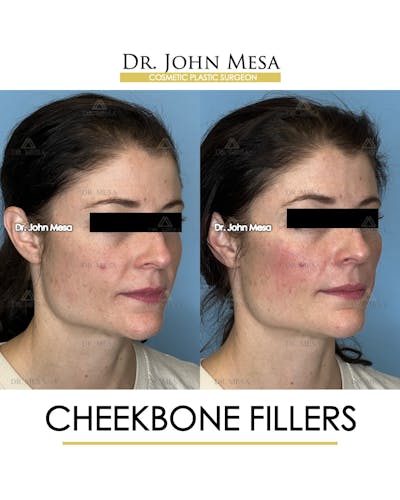 Cheekbone Filler Before & After Gallery - Patient 418893 - Image 2
