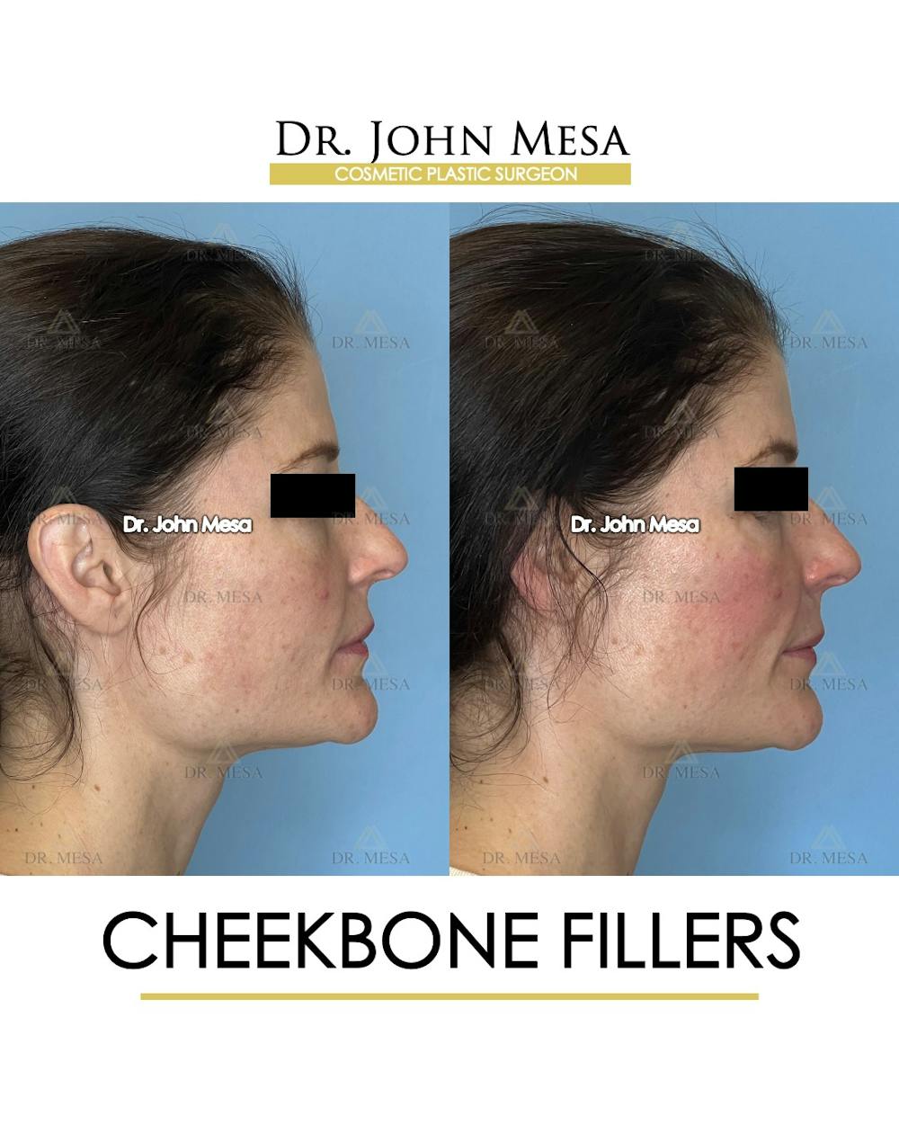 Cheekbone Filler Before & After Gallery - Patient 418893 - Image 3