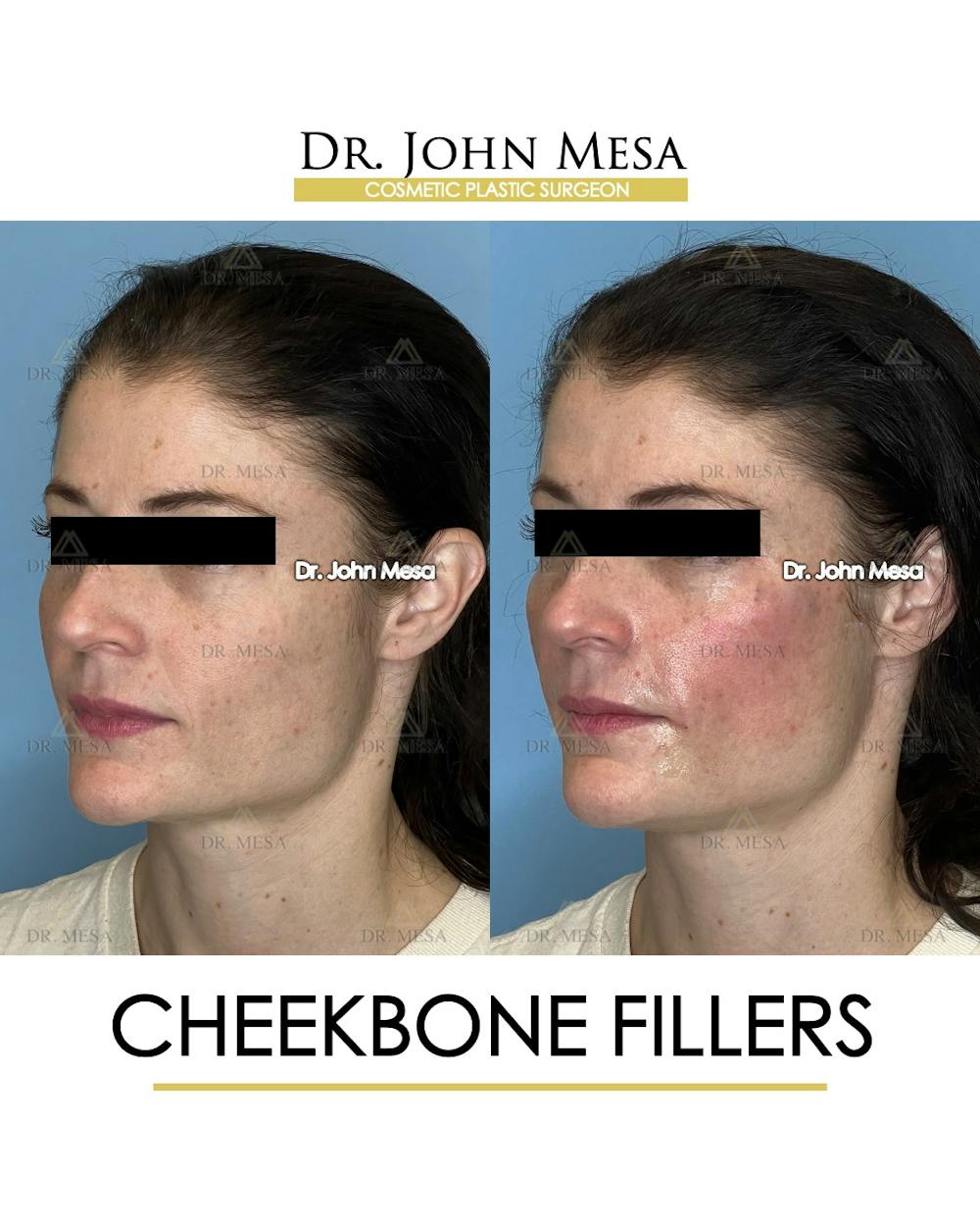 Cheekbone Filler Before & After Gallery - Patient 418893 - Image 4