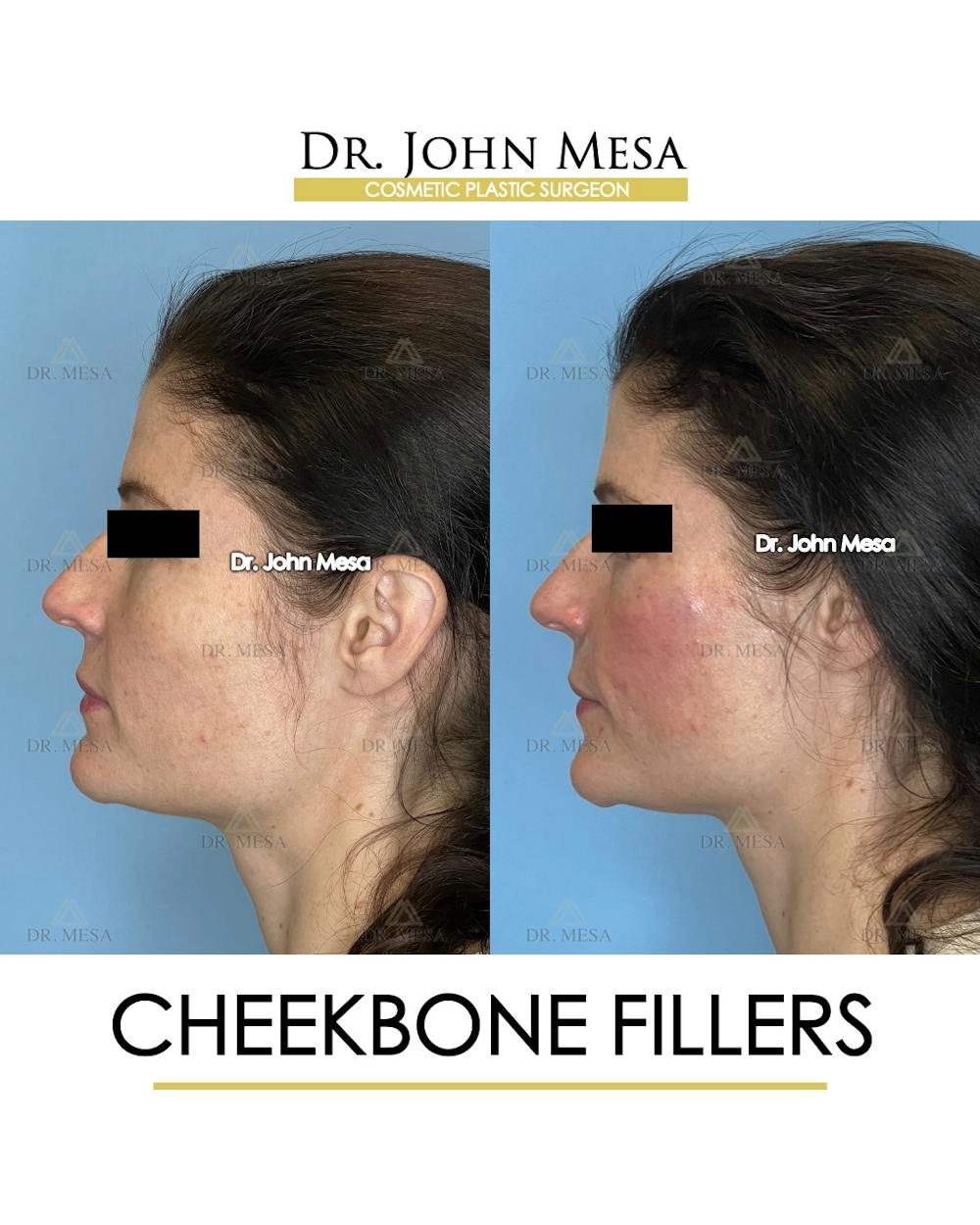 Cheekbone Filler Before & After Gallery - Patient 418893 - Image 5