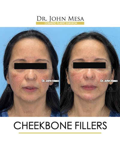 Cheekbone Filler Before & After Gallery - Patient 423674 - Image 1