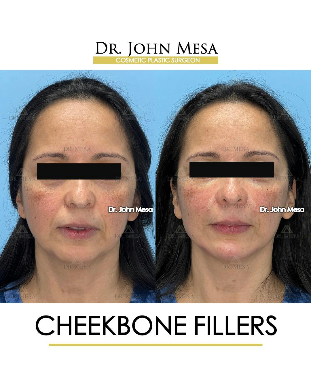 Cheekbone Filler Before & After Gallery - Patient 423674 - Image 1