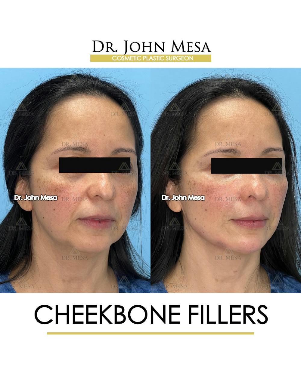 Cheekbone Filler Before & After Gallery - Patient 423674 - Image 2