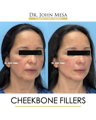 Cheekbone Filler Before & After Gallery - Patient 423674 - Image 2