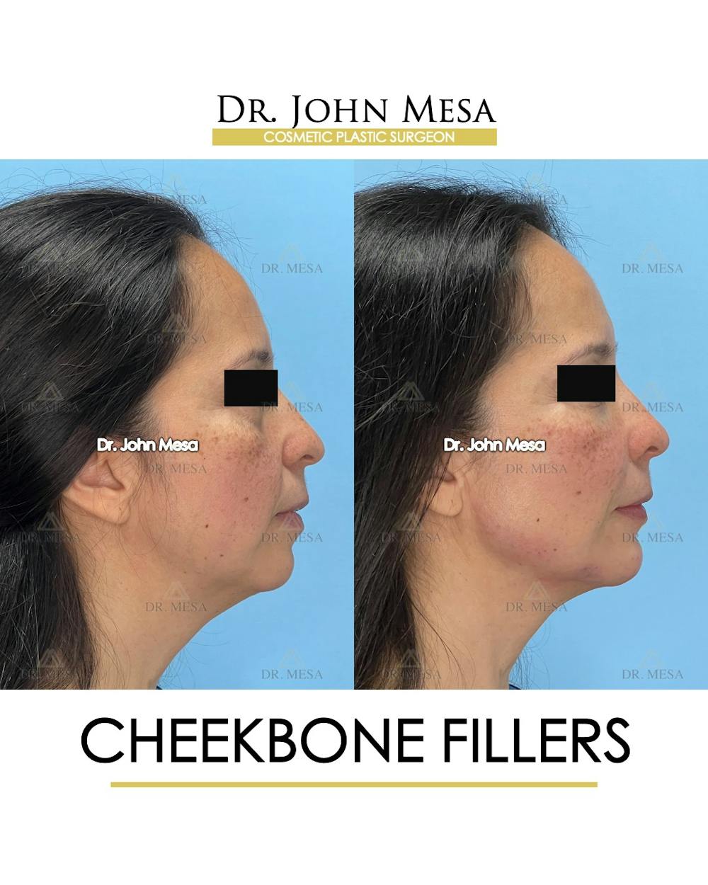 Cheekbone Filler Before & After Gallery - Patient 423674 - Image 3