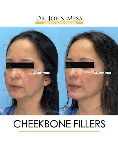 Cheekbone Filler Before & After Gallery - Patient 423674 - Image 4