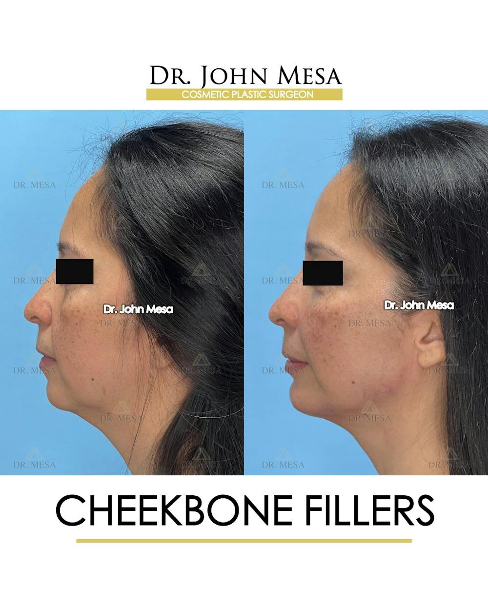 Cheekbone Filler Before & After Gallery - Patient 423674 - Image 5