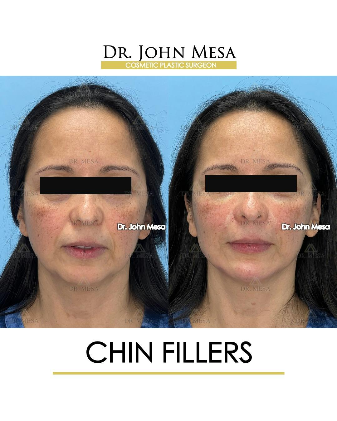 Chin Filler Before & After Gallery - Patient 306117 - Image 1