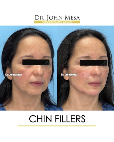 Chin Filler Before & After Gallery - Patient 306117 - Image 2