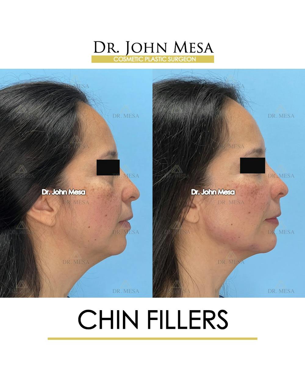 Chin Filler Before & After Gallery - Patient 306117 - Image 3