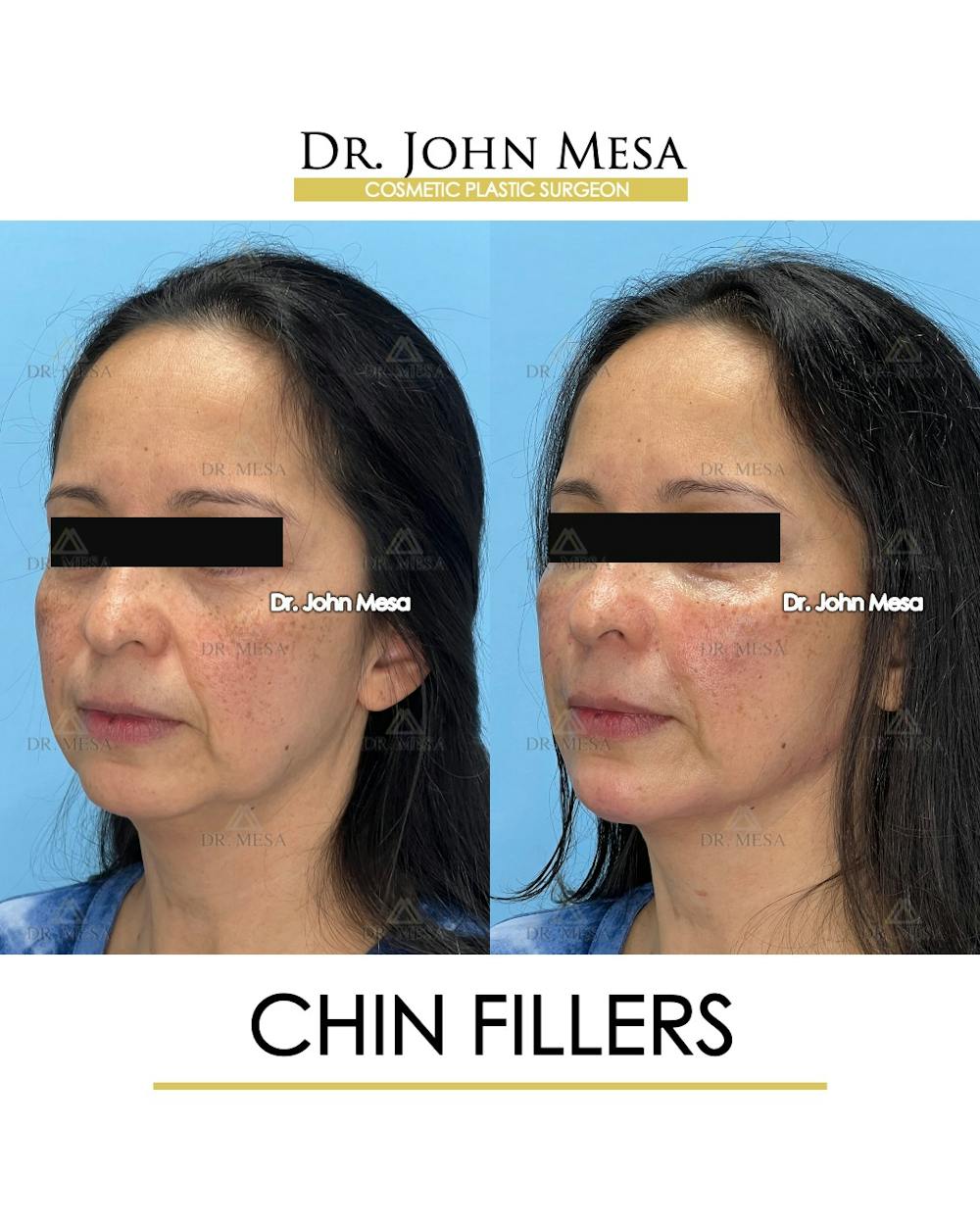 Chin Filler Before & After Gallery - Patient 306117 - Image 4