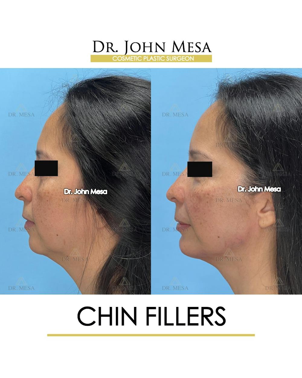 Chin Filler Before & After Gallery - Patient 306117 - Image 5
