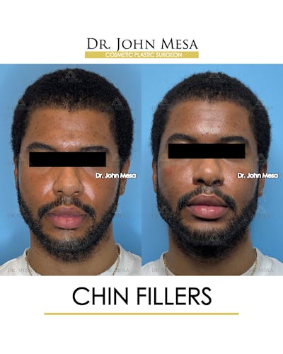 Chin Filler Before & After Gallery - Patient 169252 - Image 1