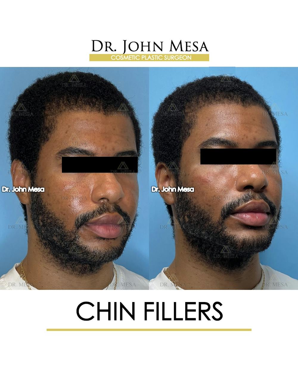 Chin Filler Before & After Gallery - Patient 169252 - Image 2