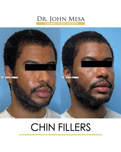 Chin Filler Before & After Gallery - Patient 169252 - Image 2