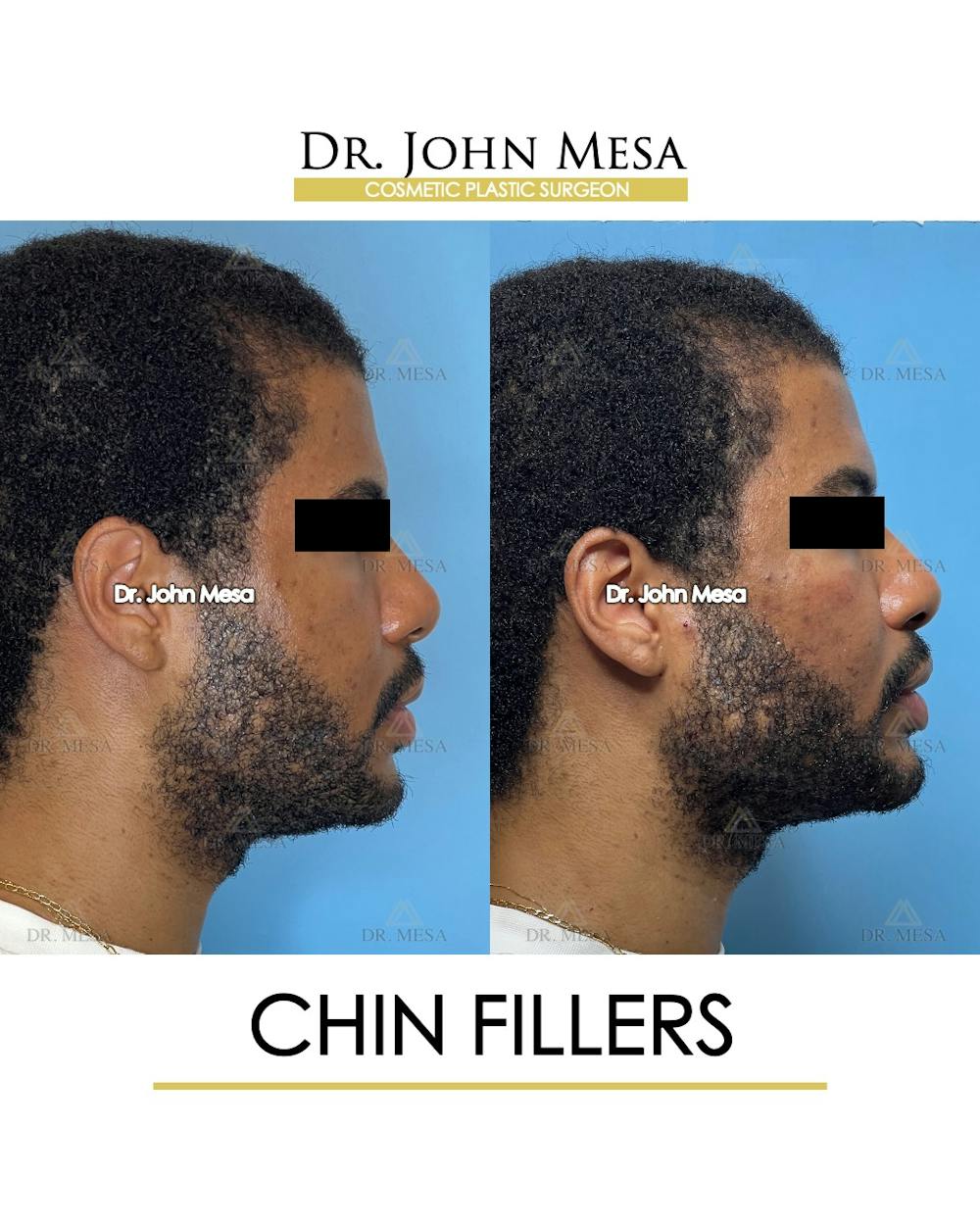 Chin Filler Before & After Gallery - Patient 169252 - Image 3