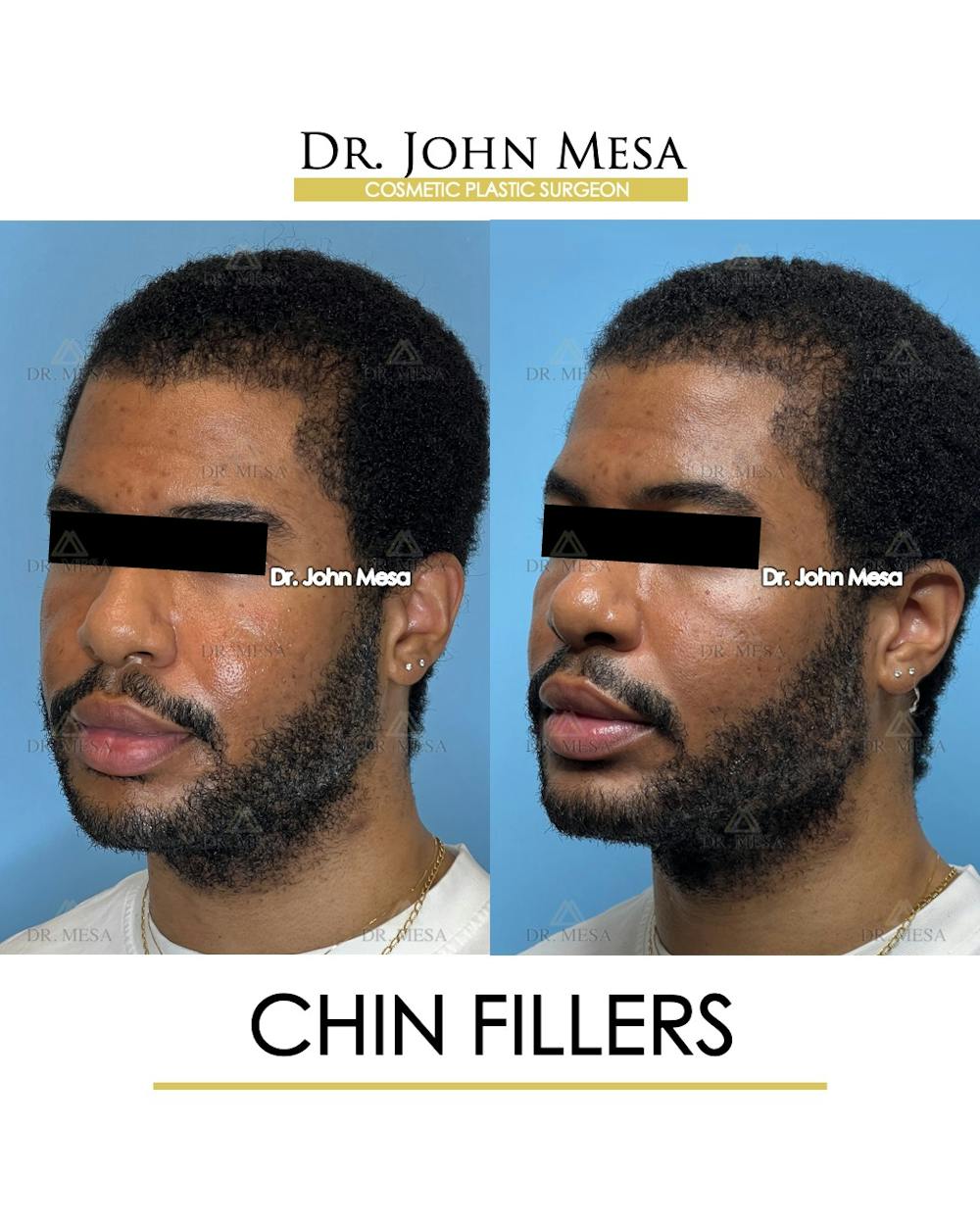 Chin Filler Before & After Gallery - Patient 169252 - Image 4