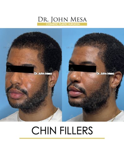 Chin Filler Before & After Gallery - Patient 169252 - Image 4
