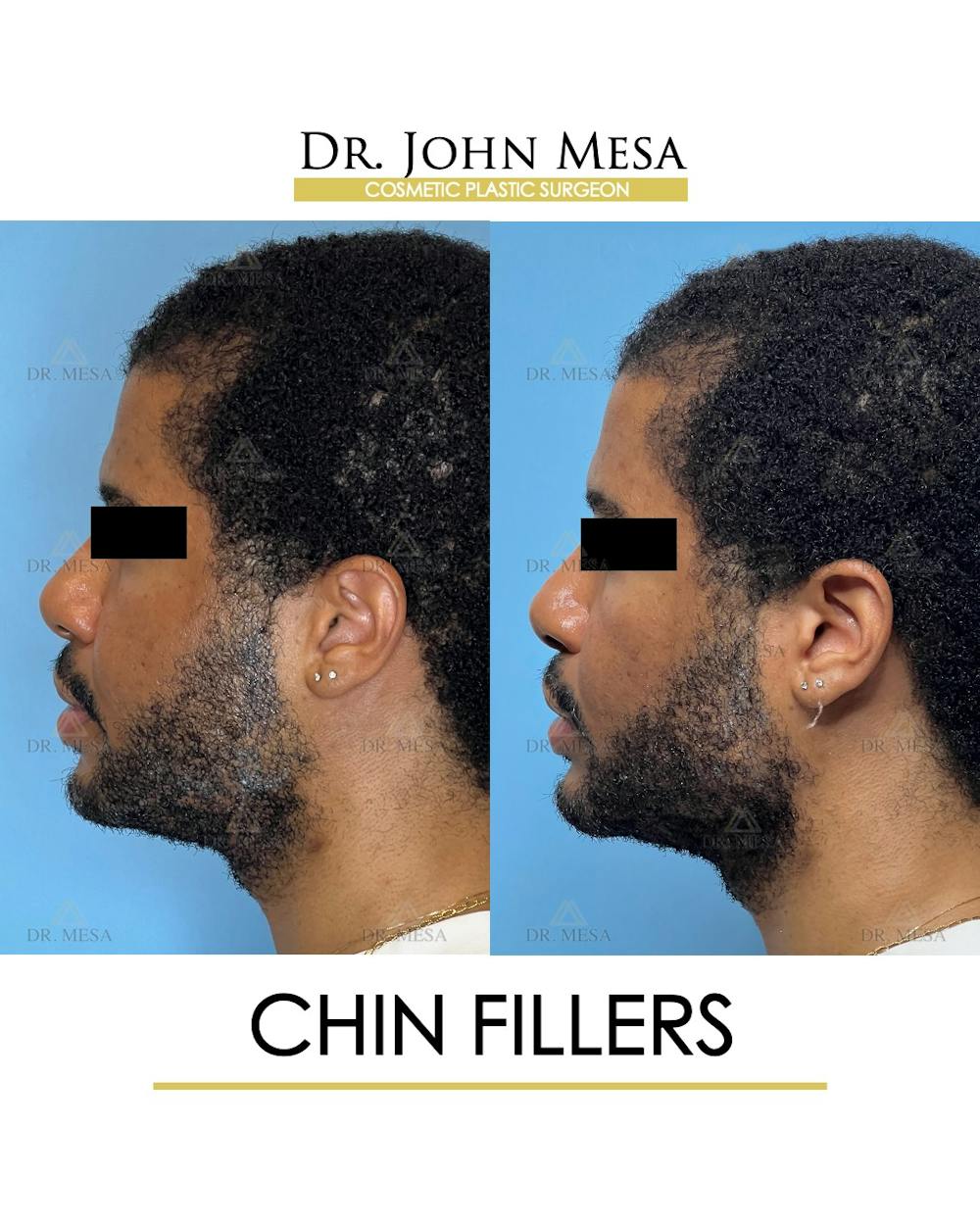 Chin Filler Before & After Gallery - Patient 169252 - Image 5